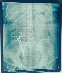 Due to the negligence of the doctor, Sandhya Pandey has been living with a scissor in her stomach for 17 years