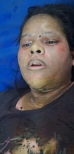 Entered the house and poured inflammable substance on the woman and set her on fire, referred to Delhi for treatment.