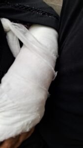 Lucknow: Despite the Chief Minister's orders, potholes are not being filled, e-rickshaw overturned, woman's arm broken